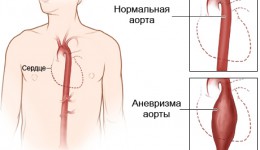 Аневризма аорты (расслоение аорты)