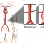 Симптомы и признаки расслаивающей аневризмы аорты