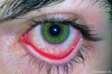 Конъюнктивит вирусный у взрослого человека